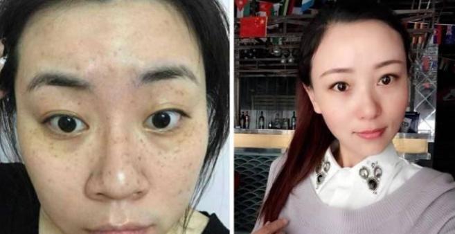 快速祛除老年斑的有效方法（教你简单又快速消除老年斑的养肤秘诀）  第3张