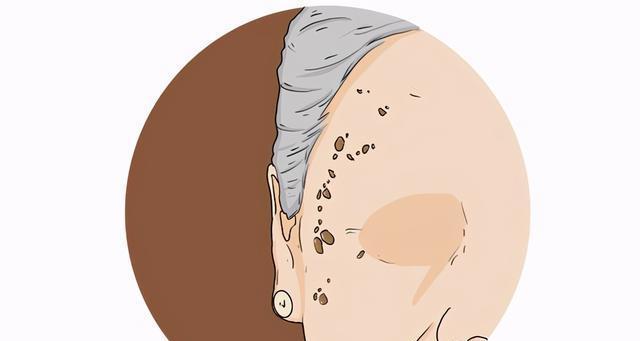 快速祛除老年斑的有效方法（教你简单又快速消除老年斑的养肤秘诀）  第2张