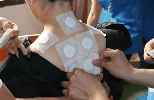 三伏贴中途漏了一贴有没有效果?三伏贴中间少了一次效果如何