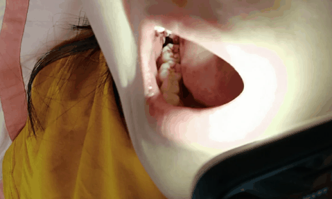 拔智齿48小时刚到立即热敷吗3