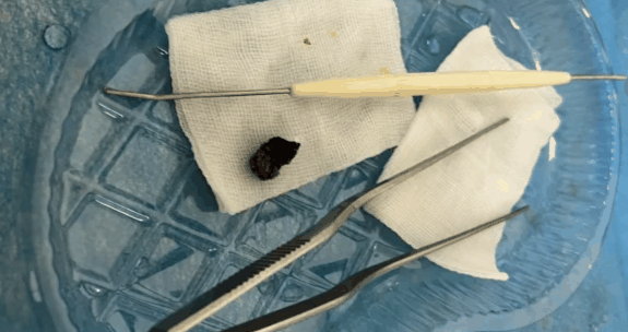 医院耳朵清理挂什么科?医院耳朵清理疼不疼插图2 医院耳朵清理挂什么科3