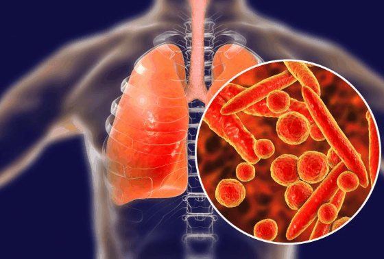 支原体肺炎会引起肺纤维化吗?支原体肺炎会引起肺空洞吗