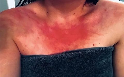 美国女子确诊水源性荨麻疹 喝水洗澡都发作！但她勇敢记录了洗澡过程