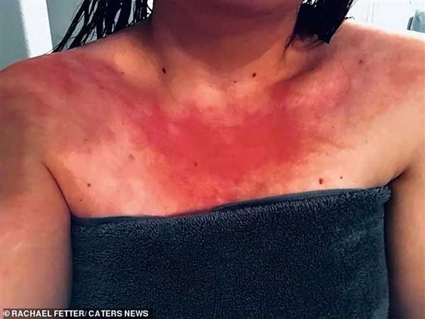 美国女子确诊水源性荨麻疹 喝水洗澡都发作！但她勇敢记录了洗澡过程