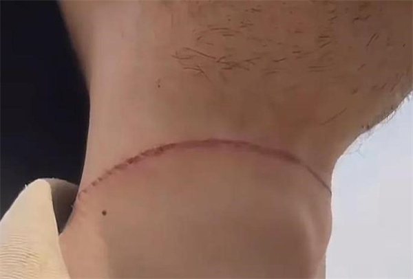 大学生骑车遭风筝线割喉怎么回事 风筝线的危害