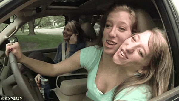 美国著名连体双胞胎共享身体 一个已婚想生孩子 另一个咋办插图7 美国著名连体双胞胎共享身体 一个已婚想生孩子 另一个咋办