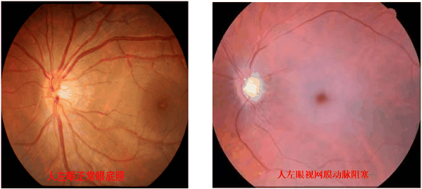 95后妈妈一觉醒来右眼失明！医生：已错过最佳抢救时机