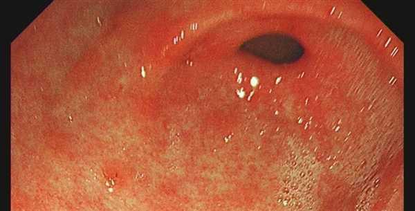 2个人中就有1人感染:医生让查幽门螺旋杆菌是真的想救你!插图 2个人中就有1人感染:医生让查幽门螺旋杆菌是真的想救你!