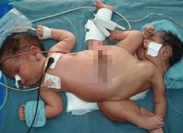患病几率200万分之一：印尼蜘蛛连体双胞胎成功切除第3条腿
