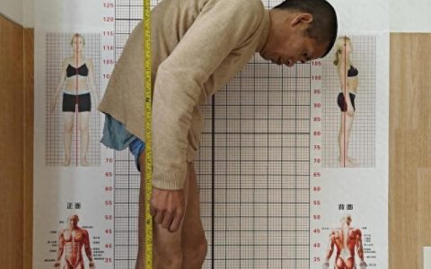 强直性脊柱炎困扰十余年，余姚邦尔医院精湛手术助患者重拾人生