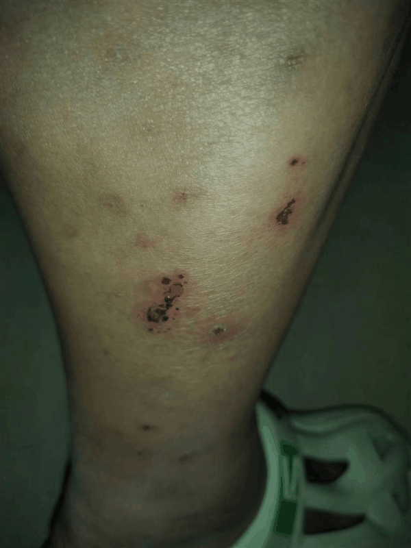 游野泳后小伙的腿竟红肿流脓高烧41度：感染了“丹毒”