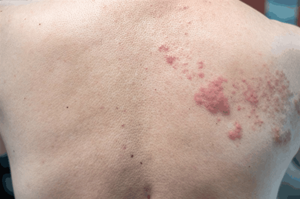 “那英哭了”上热搜！这种病剧痛犹如灼烧 医生提醒