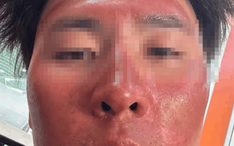 男子爬雪山晒伤成面膜脸：大面积流脓 脱皮