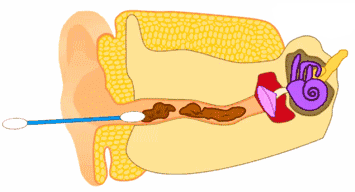 医生都叫别掏耳朵！真的不怕耳屎堵住吗？我看过视频