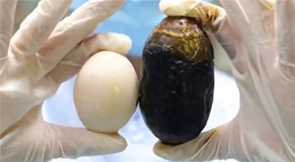 70岁老太体内暗藏125克胆结石：胆囊差点被撑爆