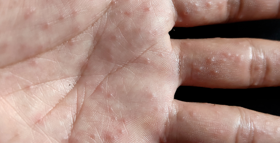 奇痒无比！夏天手上超爱长的“小水泡” 到底怎么对付呀