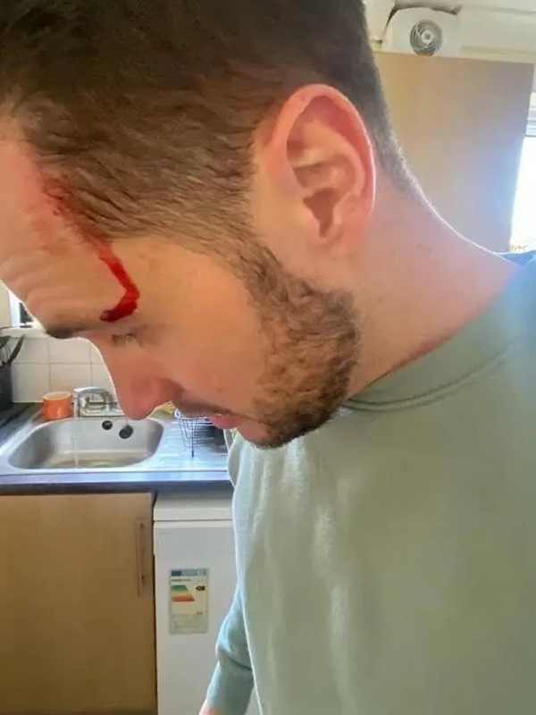 英国一只老鹰专门袭击高个男性 尤其青睐秃头