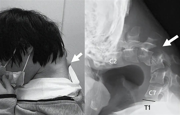 25岁日本男子沉迷于玩手机 脖子长角 颈椎弯曲几近对折无法抬头