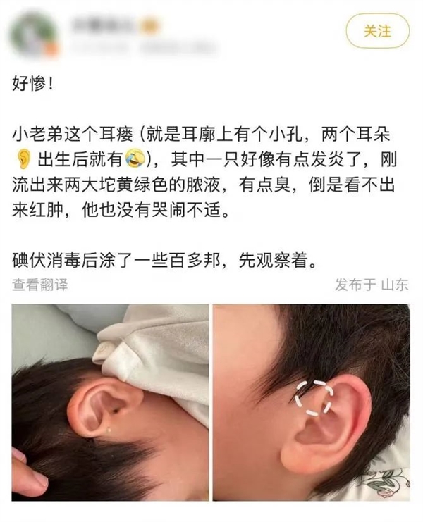 可怕！耳朵上的这个小洞 可能是个不定时炸弹
