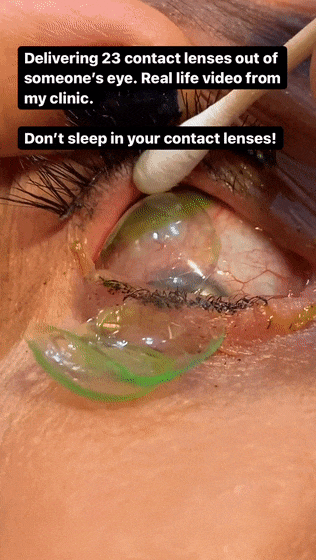 女子眼睛里竟藏了23个隐形眼镜！像煎饼一样叠着 竟无知觉