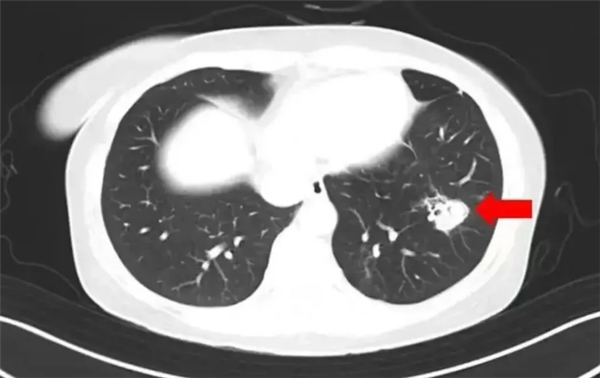 女子整理发霉衣柜后高烧40度：感染曲霉菌