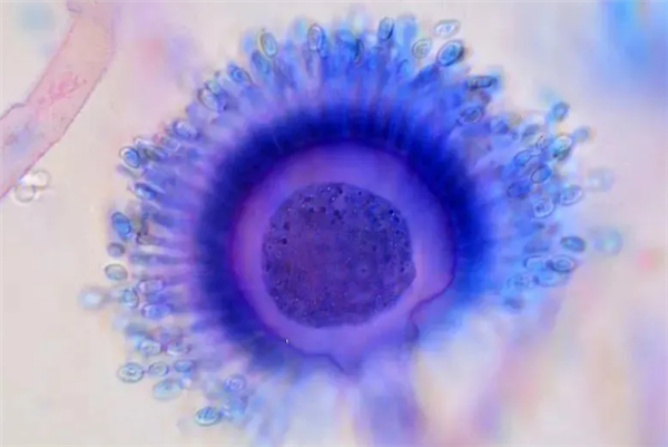 女子整理发霉衣柜后高烧40度：感染曲霉菌