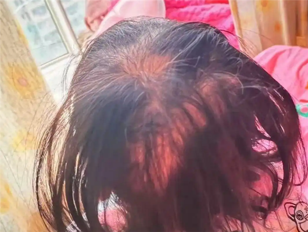 3岁女童突然脱发：查出铊中毒 眼神呆滞