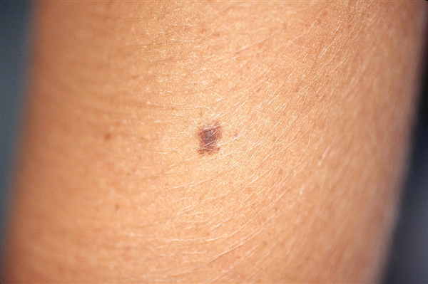 会癌变的痣一般有5个特征：请格外当心