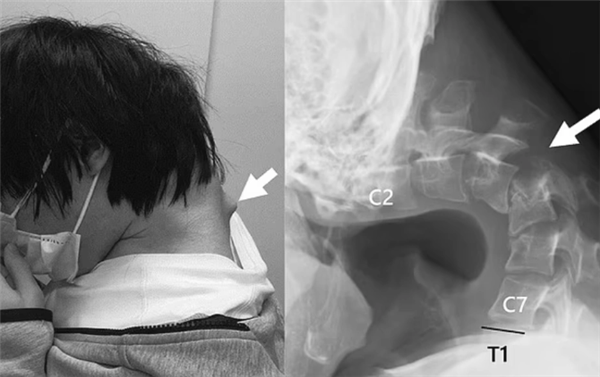 日本25岁男子沉迷手游致脖子长角：无法抬起头 出现吞咽困难