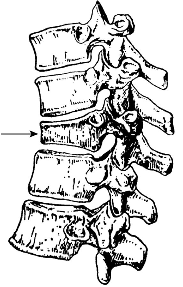 女子滑了一下 轻轻坐地 竟然就腰椎骨折了