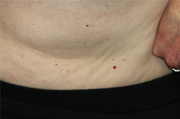 身上突然长的小红点到底是什么：会癌变吗