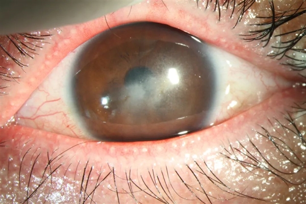 眼科医生气到拍桌子：这5件事再干下去 眼睛真要废了！