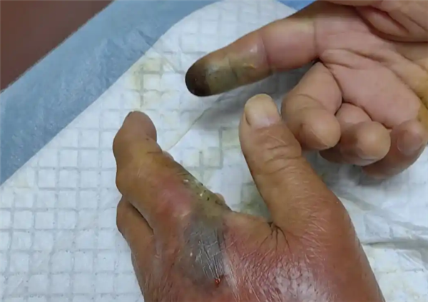 男子被毒蛇咬伤 忍痛抓又被来一口 专家：保命方法必须记住