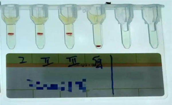比“熊猫血”还稀有！云南检出一例全球罕见的小p血型