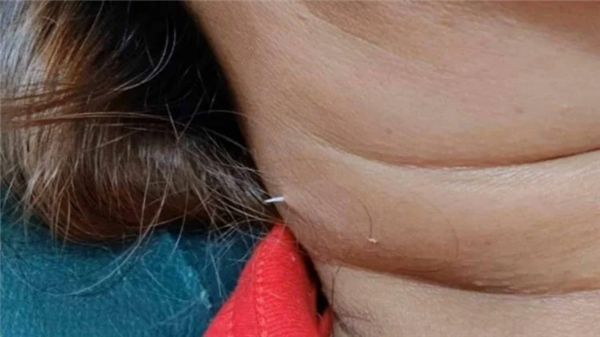 女子被鱼刺卡喉2周 2次就医均没发现 最终鱼刺从脖子穿出