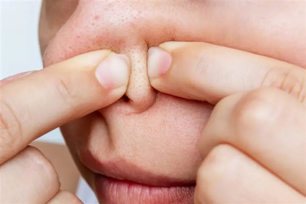 真的想问:下巴凸起的小颗粒 到底是什么呀!插图2 真的想问:下巴凸起的小颗粒 到底是什么呀!