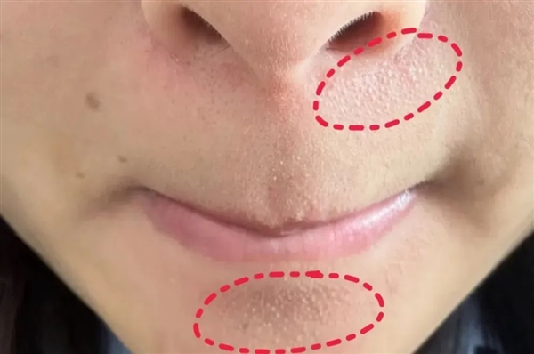 真的想问:下巴凸起的小颗粒 到底是什么呀!插图 真的想问:下巴凸起的小颗粒 到底是什么呀!