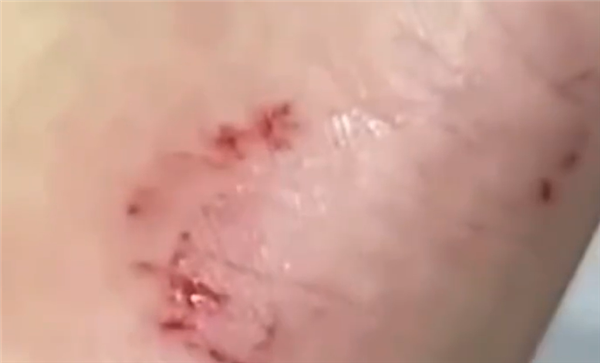 异宠博主给黑王蛇换水被咬住数秒：擦了点碘伏