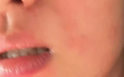 演员王楚然求助荨麻疹治疗方法：痒到崩溃 网友大呼感同身受