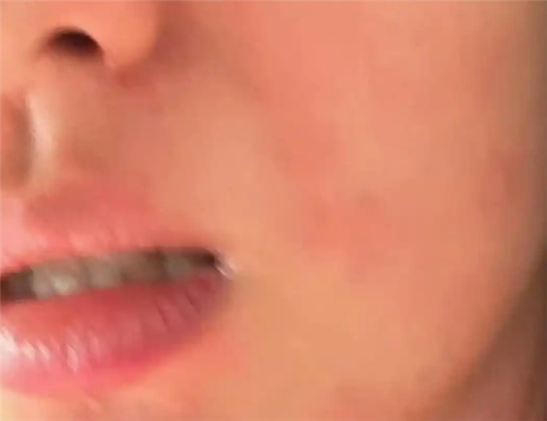 演员王楚然求助荨麻疹治疗方法：痒到崩溃 网友大呼感同身受