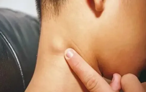 5岁男孩脖子长小疙瘩确诊癌症晚期 医生提醒插图 5岁男孩脖子长小疙瘩确诊癌症晚期 医生提醒