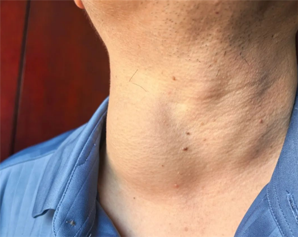 男子颈部突然肿成“鹅蛋”无法呼吸 医生：晚来半小时可能窒息死亡