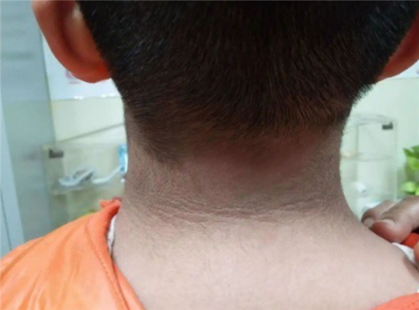 13岁男孩脖子洗不干净确诊黑棘皮病：胰岛素失控所致