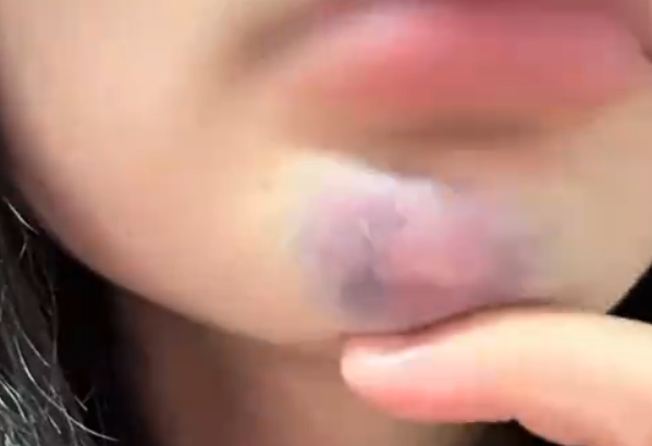 女子景区蹦极被推下受伤满脸是血 索赔得到一份免责协议