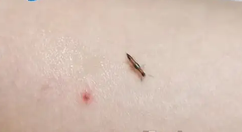 25岁女子开窗睡觉致隐翅虫飞入险毁容：半边脸全是红斑