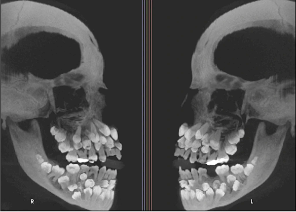 巴西一11岁女孩长了81颗牙！医生直呼活久见