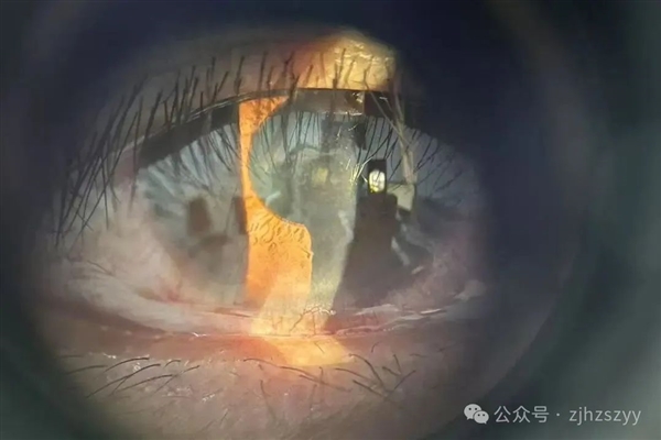 男子野外偶遇五步蛇想抓来玩：蛇毒喷到眼睛里差点失明