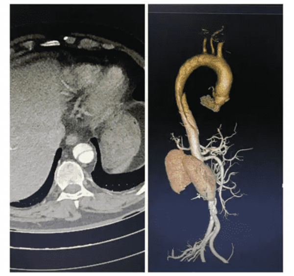 全球首款！浙大一院、阿里发布主动脉急诊AI模型：准确率高达99.4％