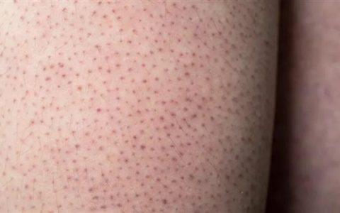 快住手！皮肤上的这些小颗粒真不是痘痘：别抠 也别随便用药