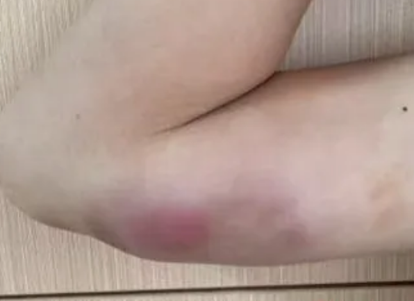 13岁男孩手臂长瘤确诊猫抓病 医生：或因其常喂流浪猫